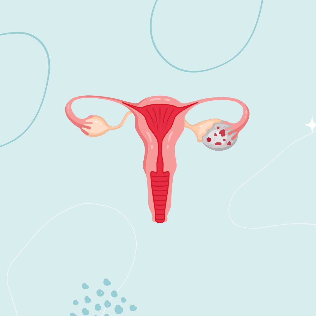 Detecting Ovarian Cancer: what women need to know