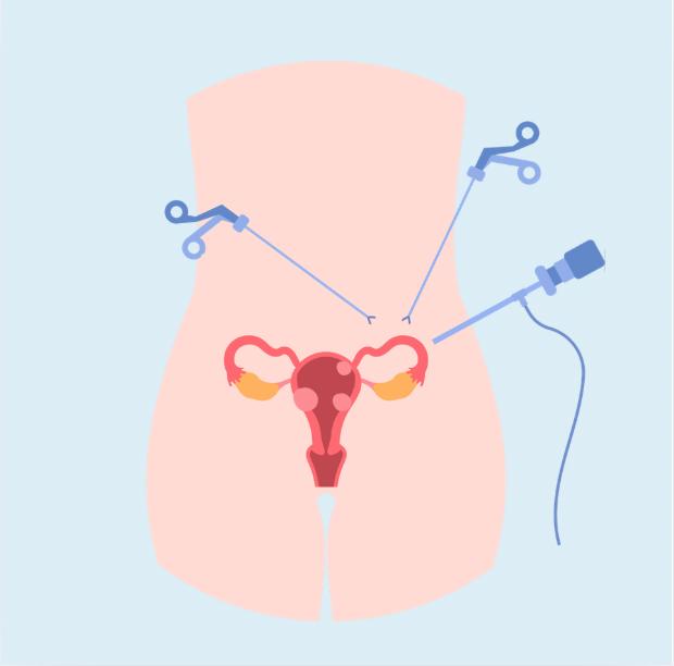 Laparoscopic Myomectomy: keyhole surgery for fibroids
