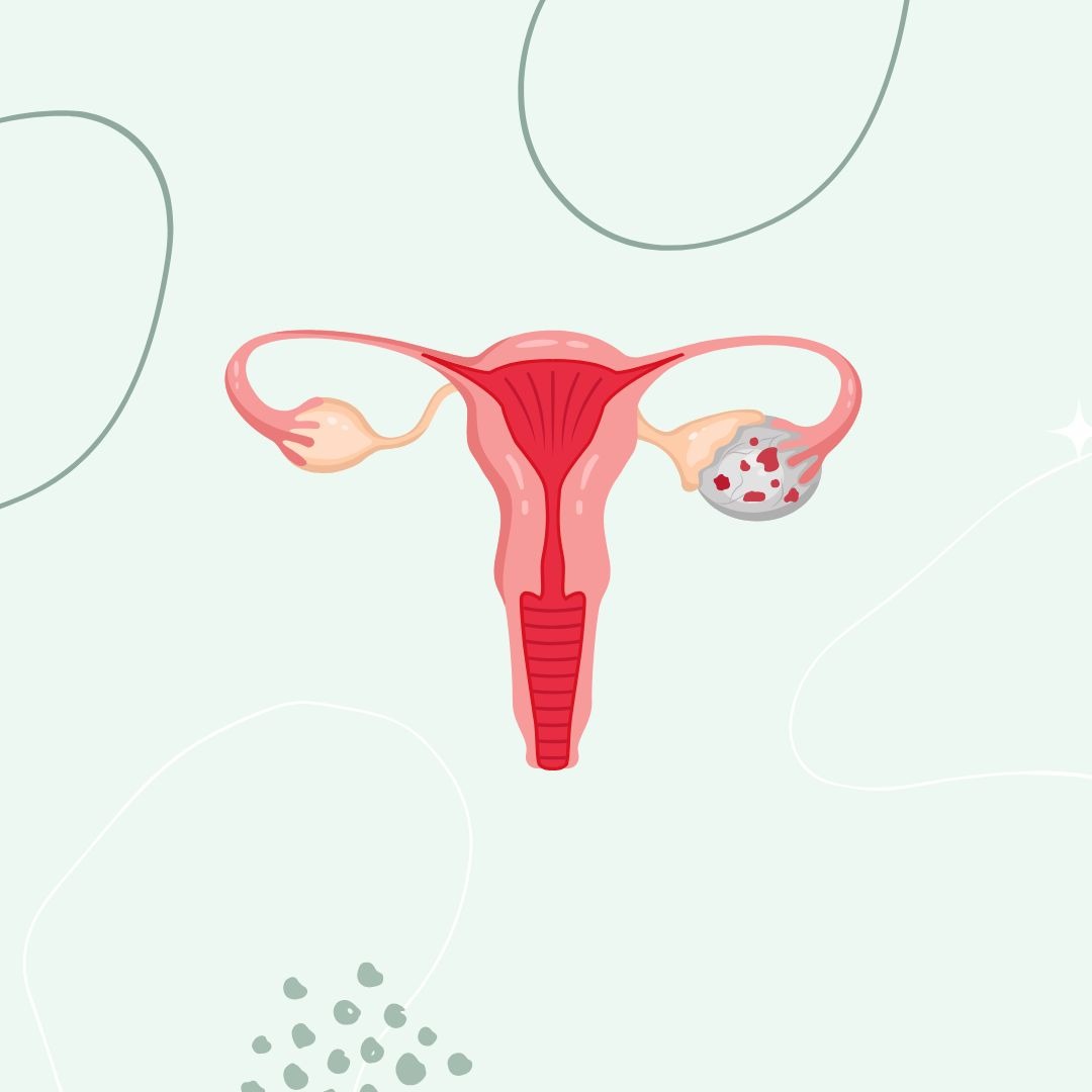 Common Myths About Ovarian Cancer: separating fact from fiction