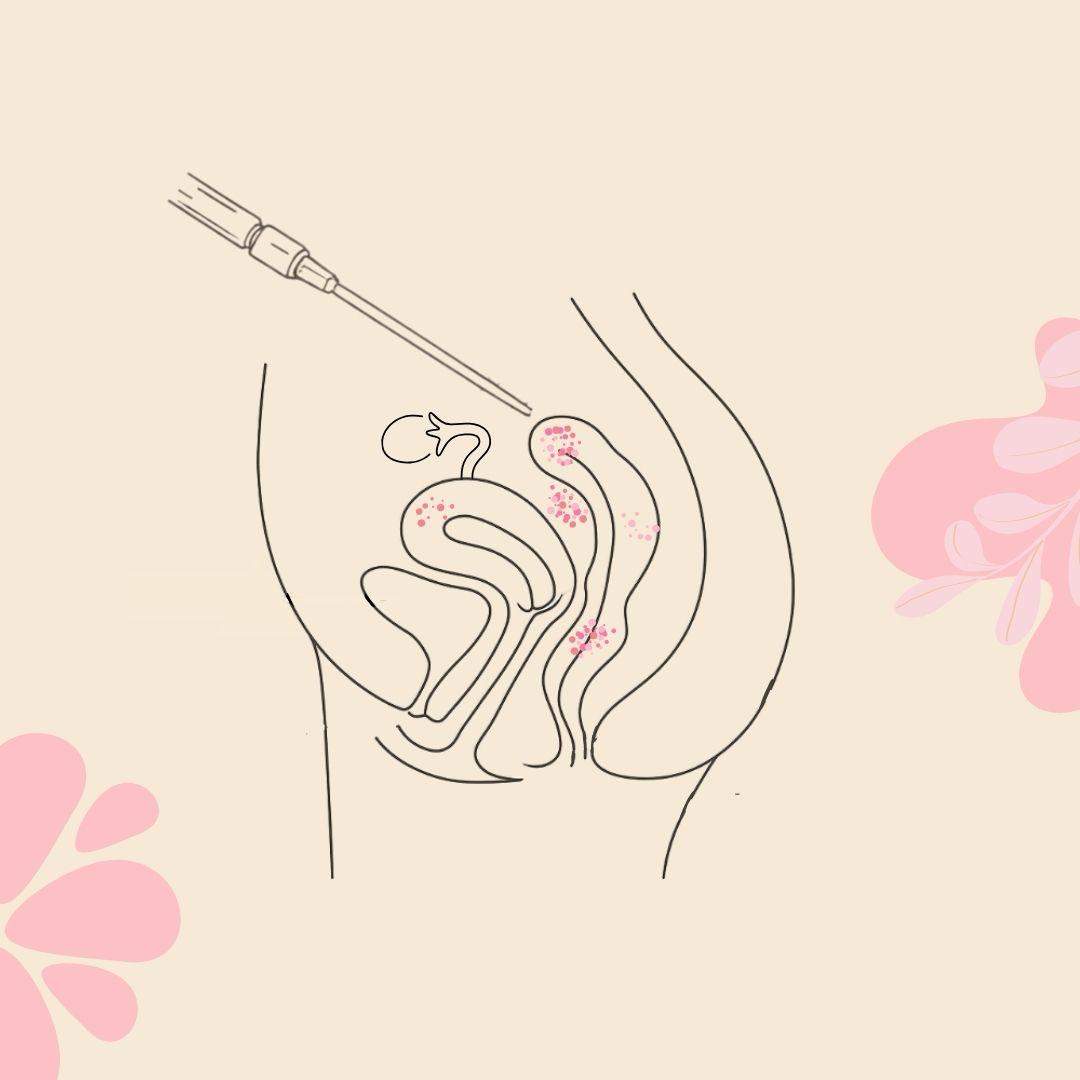 When Endometriosis Involves the Bowel: the role of a colorectal surgeon