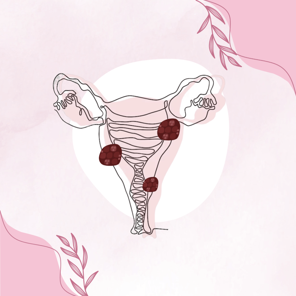 My Ultrasound Says I Have Fibroids: now what?!